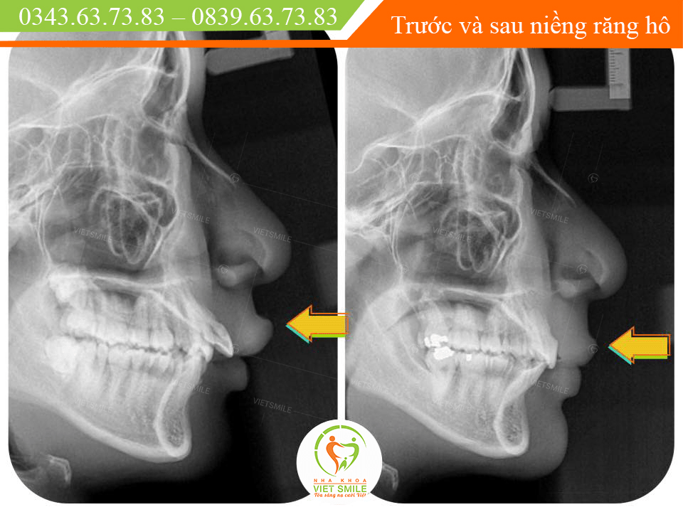 vì sao cần chụp phim x-quang khi niềng răng? 3 Vietsmile x quang so nghieng