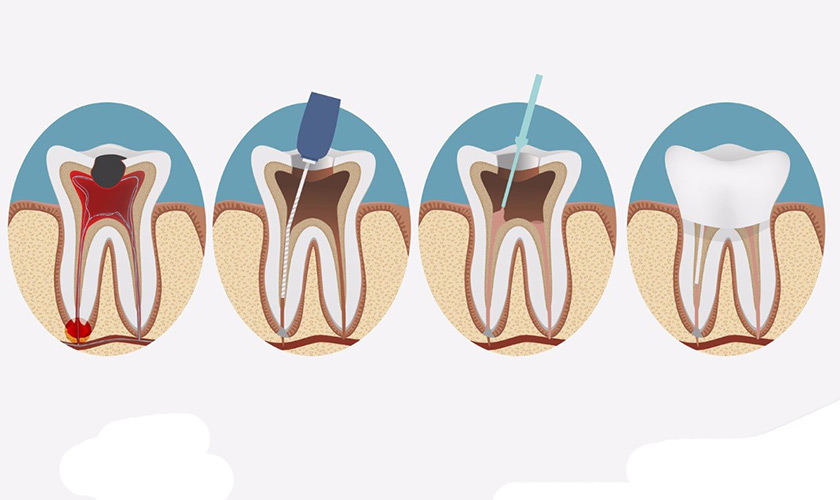 Điều trị nội nha mất bao nhiêu lần hẹn?