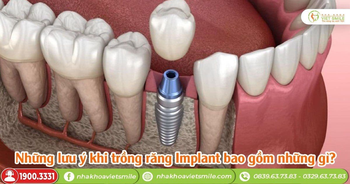 Những lưu ý khi trồng răng implant bao gồm những gì?