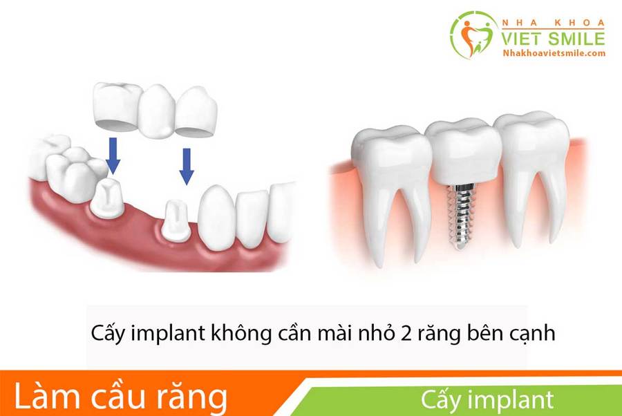 cấy ghép implant- phương pháp phục hình răng đã mất tối ưu nhất 2 Vietsmile so sanh cay ghep implant va cau rang su
