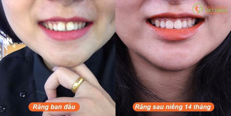 review chữa cười hở lợi an toàn tại hà nội 2 Review cắt lợi : review chữa cười hở lợi an toàn