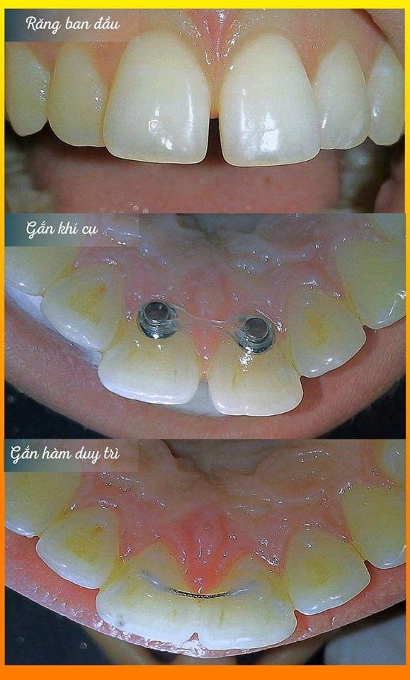 đóng kín 2 răng cửa thưa với khí cụ button 2 Vietsmile dong khe thua rang cua