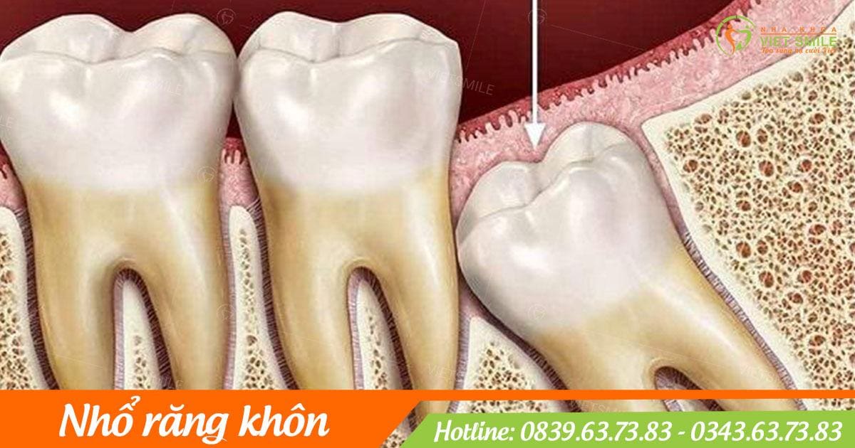 Tại sao cần nhổ răng khôn?
