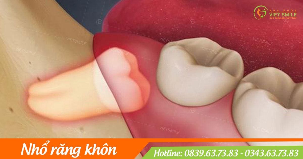 nhổ răng khôn không đau có thật không? 1 Vietsmile nho rang khon uy tin hn