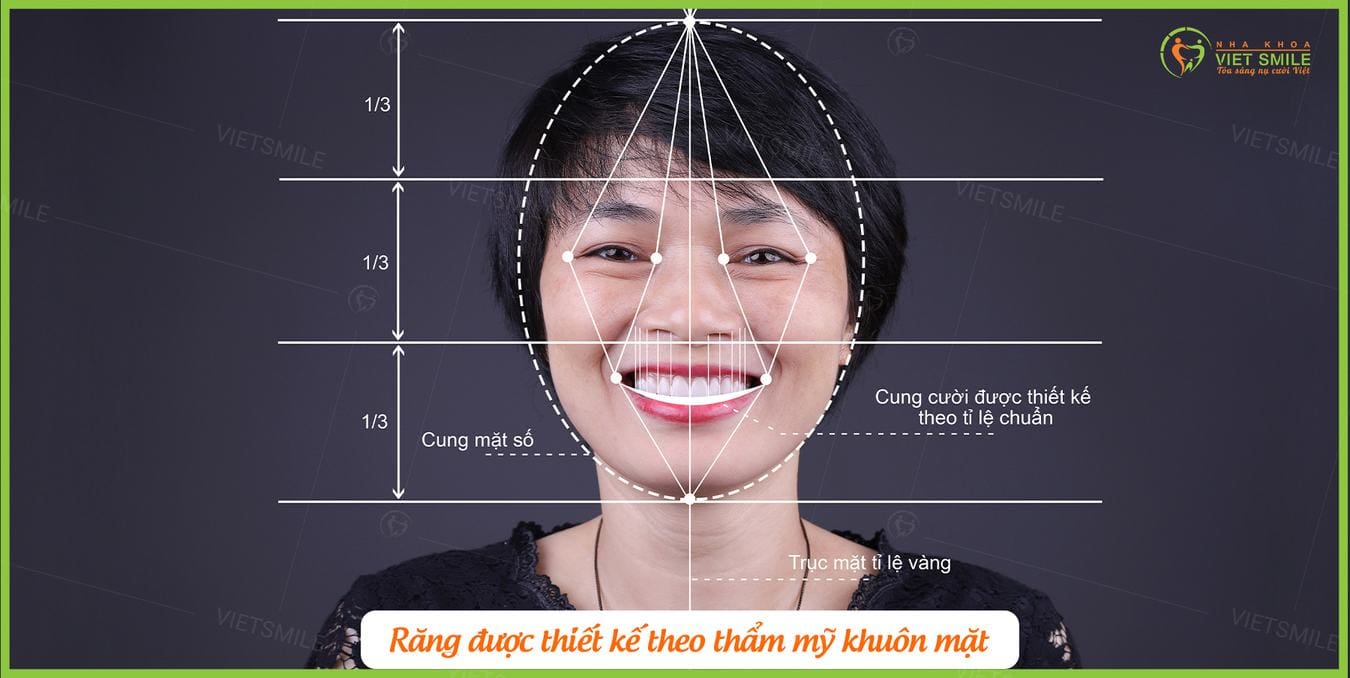 tổng hợp thông tin về mặt dán sứ veneer không mài bé răng 1 Vietsmile thong tin ve mat dan su veneer 1
