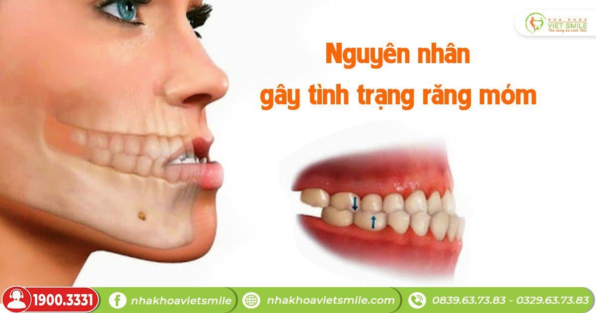 Nguyên nhân nào gây tình trạng răng móm?
