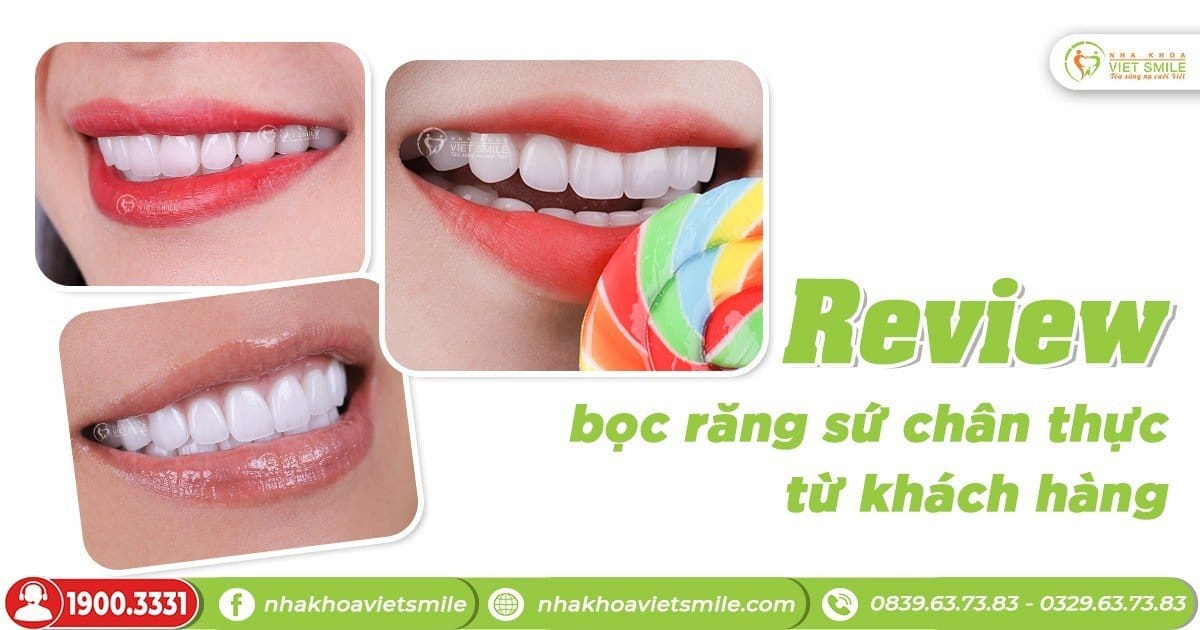 Review bọc răng sứ chân thực từ khách hàng