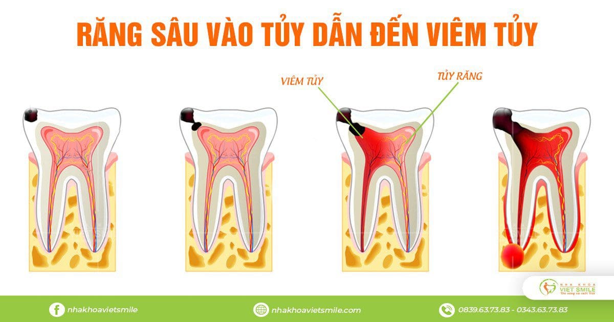 Răng sâu khiến tủy răng bị viêm nhiễm