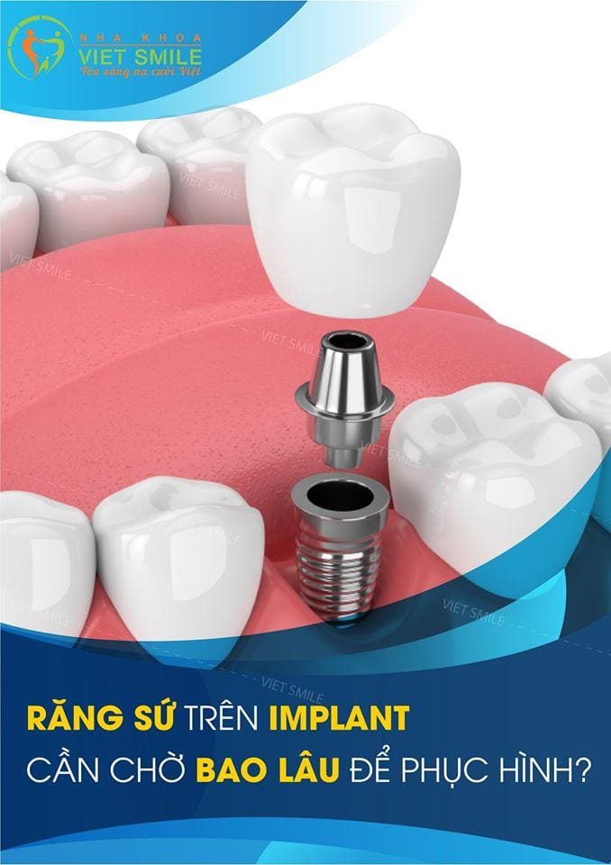 Phuc hinh rang implant