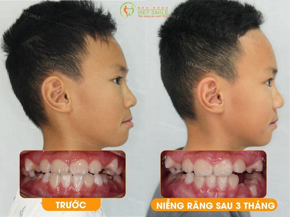 niềng răng cho trẻ có thật sự cần thiết? 2 Nieng rang tre em