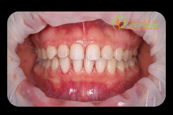 Tháo phủ sứ nano - bảo vệ nụ cười 2 Tac hai phu su nano