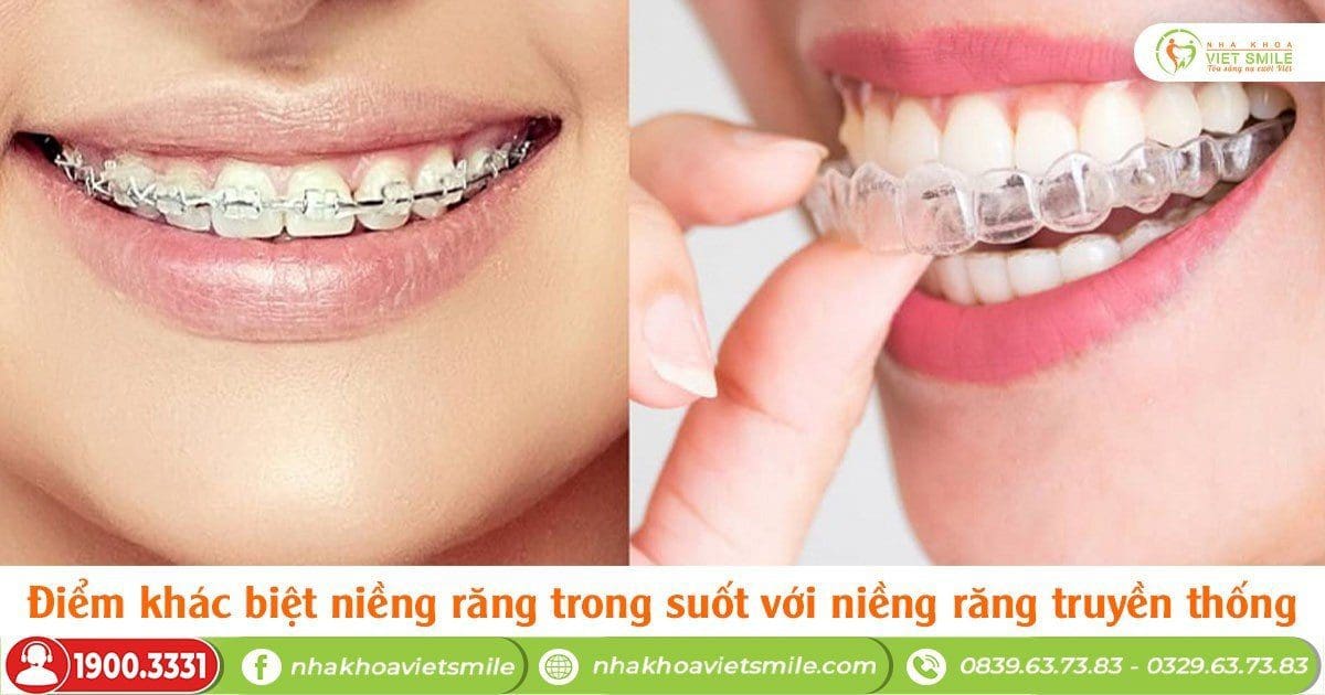 Điểm khác biệt niềng răng trong suốt với niềng răng truyền thống