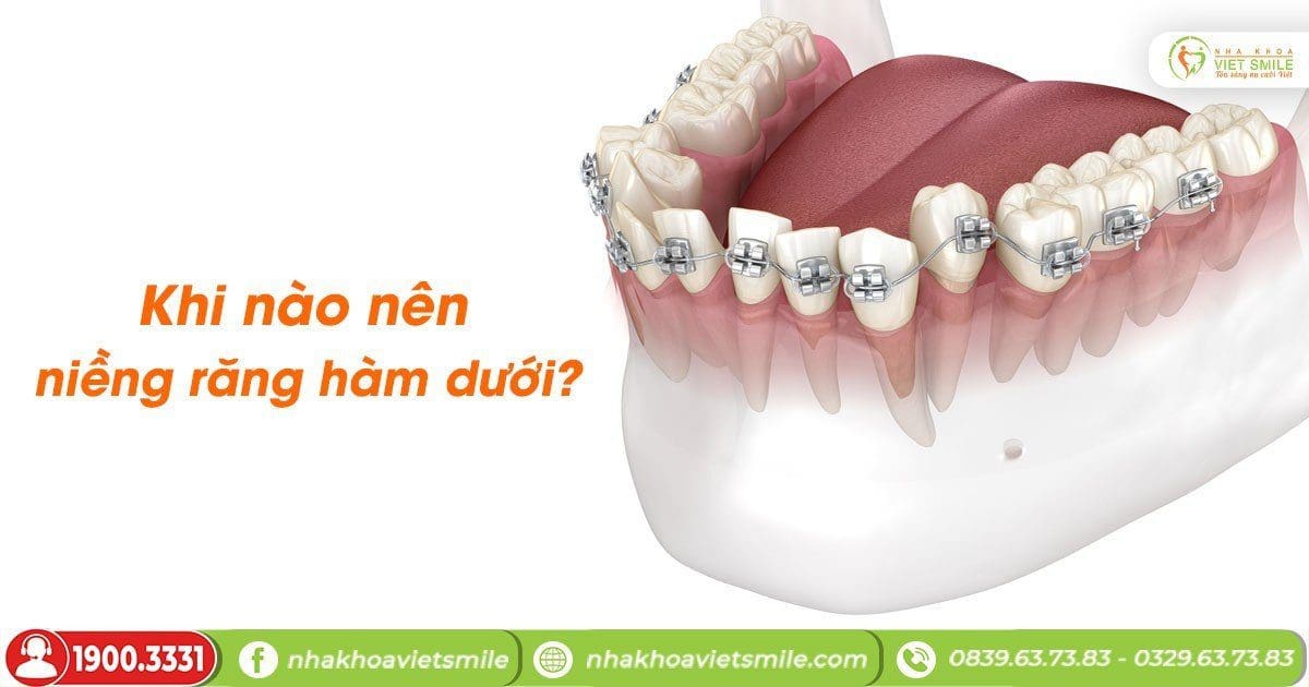 Khi nào nên niềng răng hàm dưới?