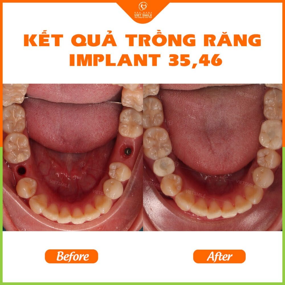 Trồng lại răng implant có đau không? 2 Phuc hinh implant