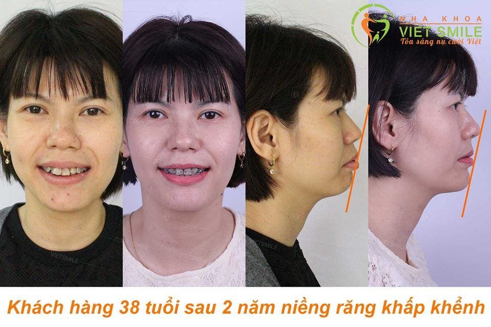 niềng răng tiết kiệm - deal siêu hời đầu năm 9 Nha khoa việt smile niềng răng bất chấp mọi tuổi tác và vấn đề