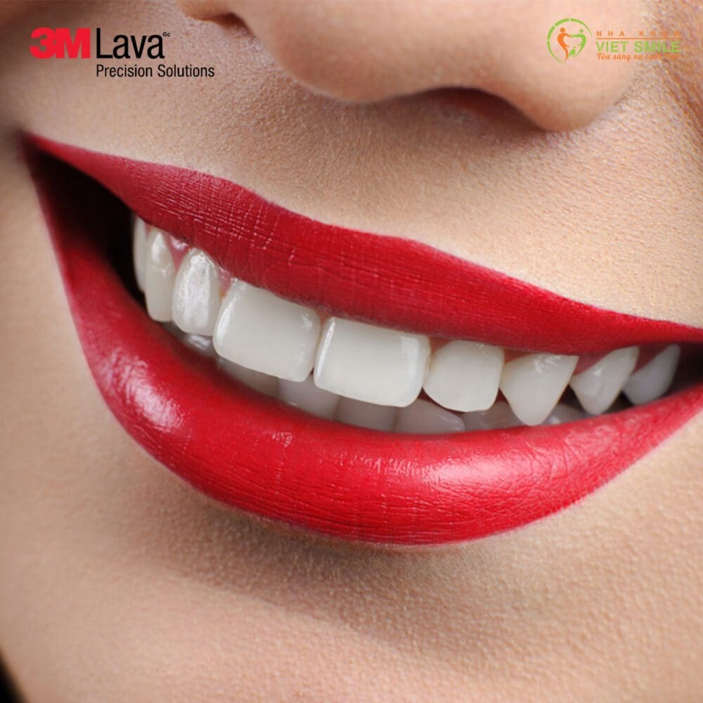 thẩm mỹ răng hoàn hảo với sứ lava plus - gc đắp tay thủ công 1 Rang su lava plus - gc