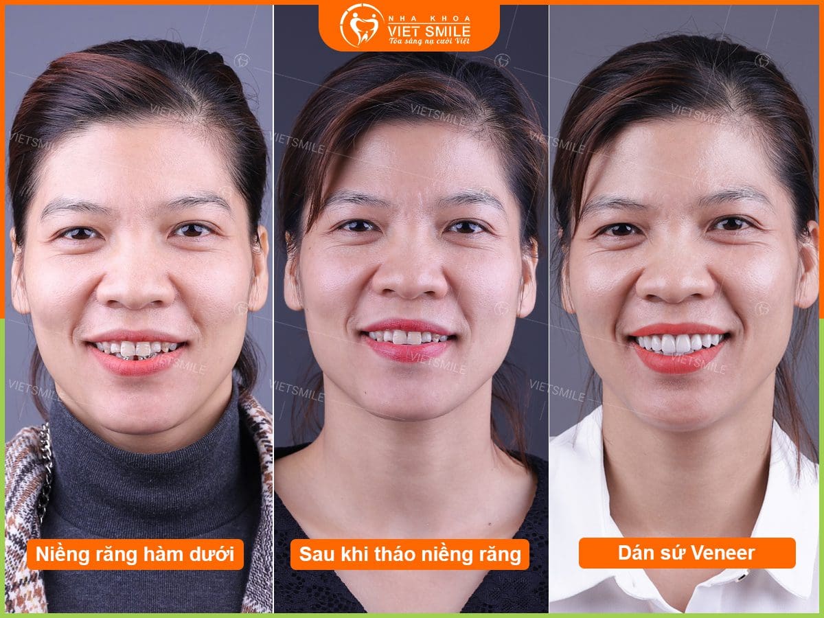 hàm răng không đều dán sứ veneer được không? 2 Nieng rang dan su veneer
