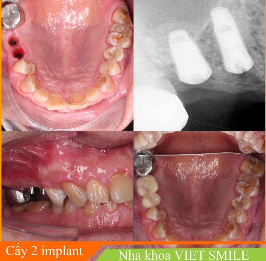 bảng giá trồng răng implant mới nhất 3 Ket qua trong rang implant