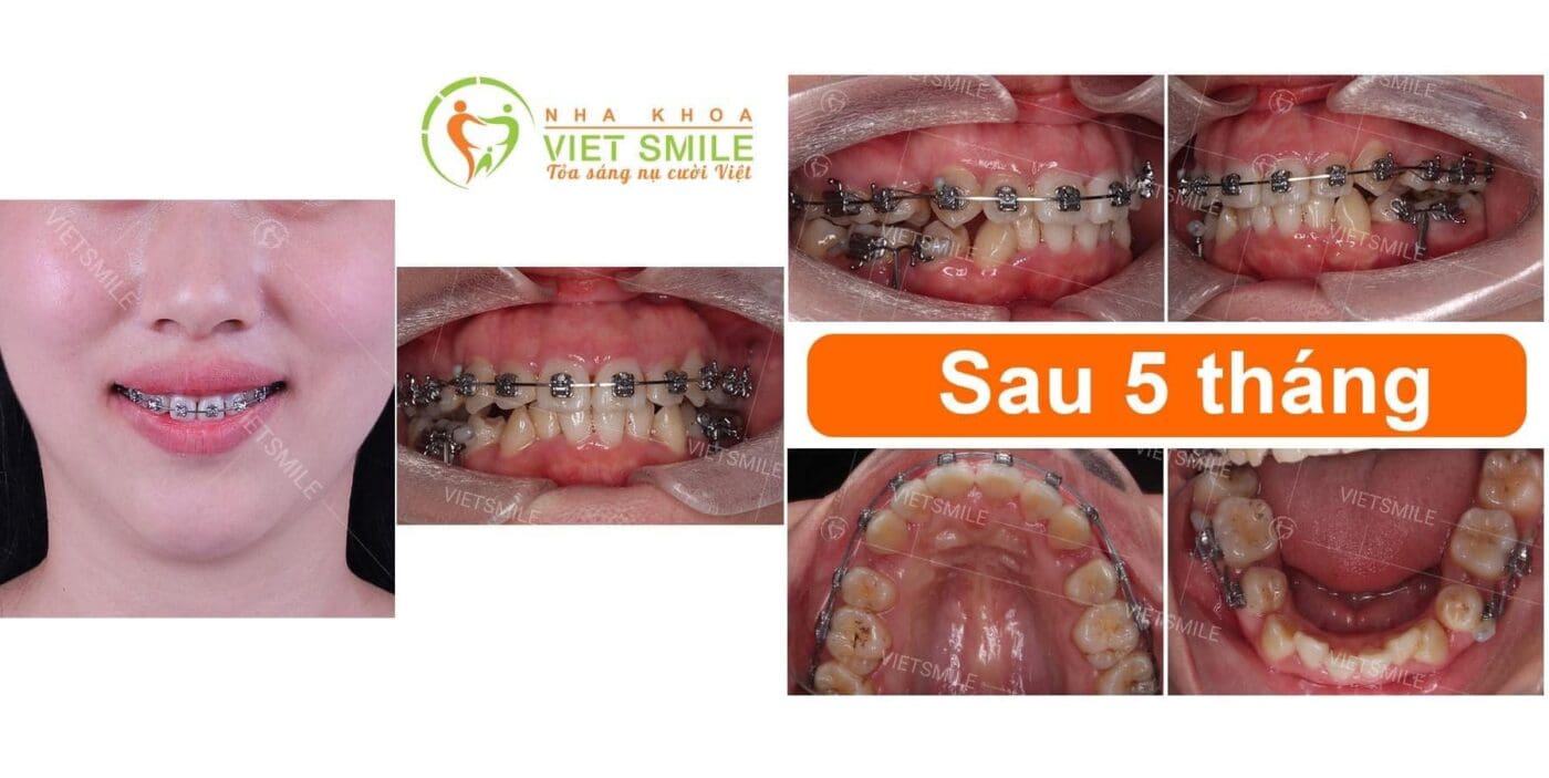 mắc cài kim loại tự động jiscop cấp độ 1 2 Sự khác biệt của nụ cười giữa trước và sau 5 tháng niềng răng