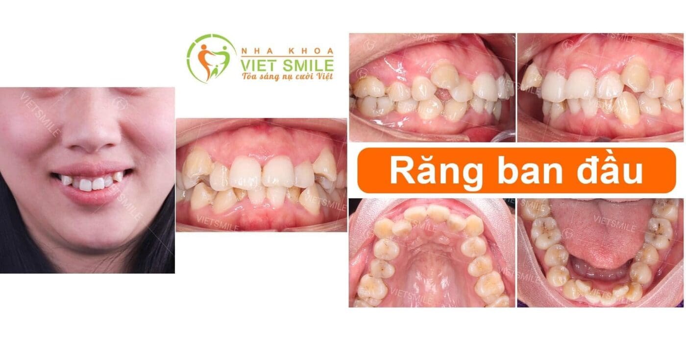 mắc cài kim loại tự động jiscop cấp độ 1 1 Tình trạng răng khấp khểnh ban đầu của khách hàng