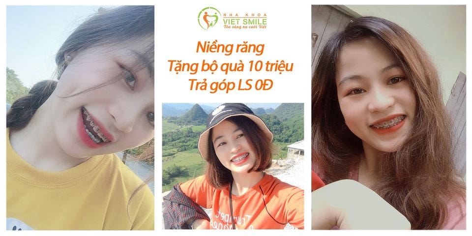 Niềng răng trả góp 2021: Bảng giá niềng răng trả góp tại phóng khám Việt Smile