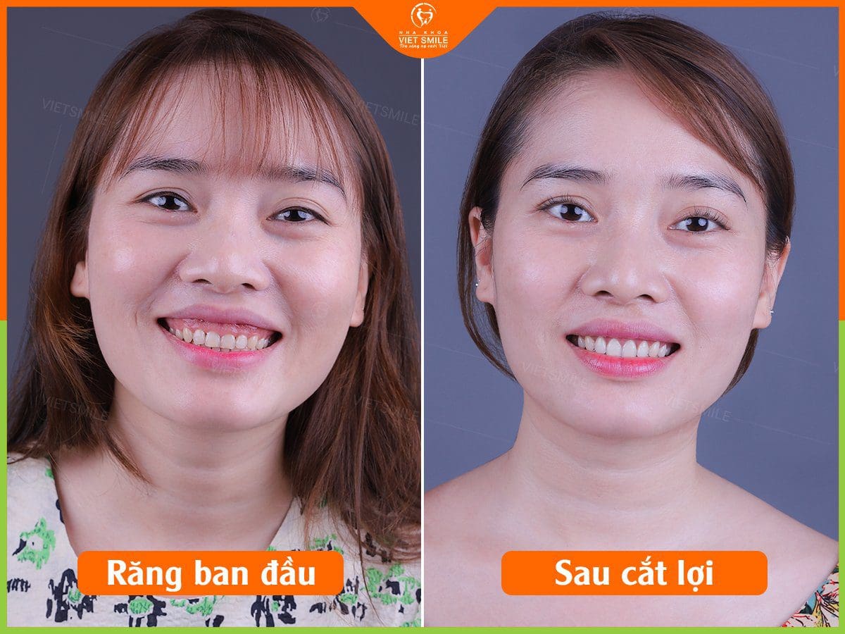 quy trình cắt lợi thẩm mỹ an toàn 2 Cat loi tham my