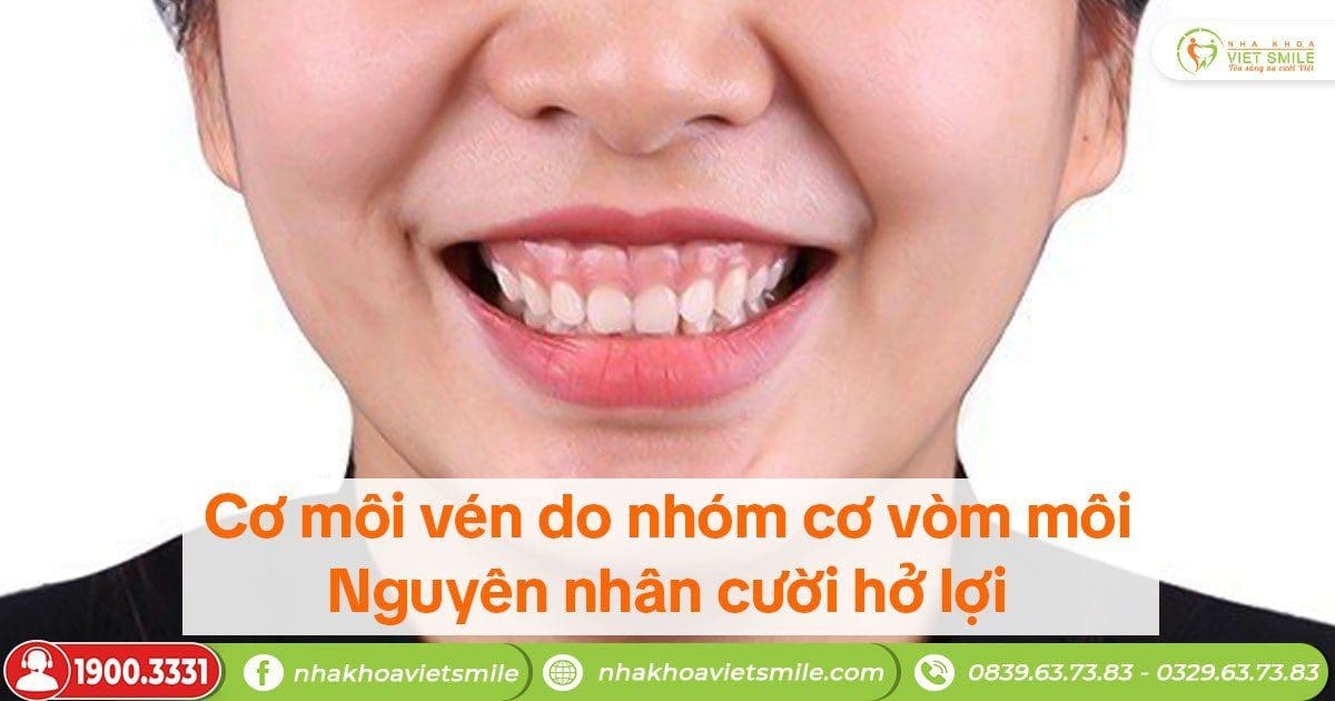 Cơ môi vén do nhóm cơ vòm môi - nguyên nhân cười hở lợi