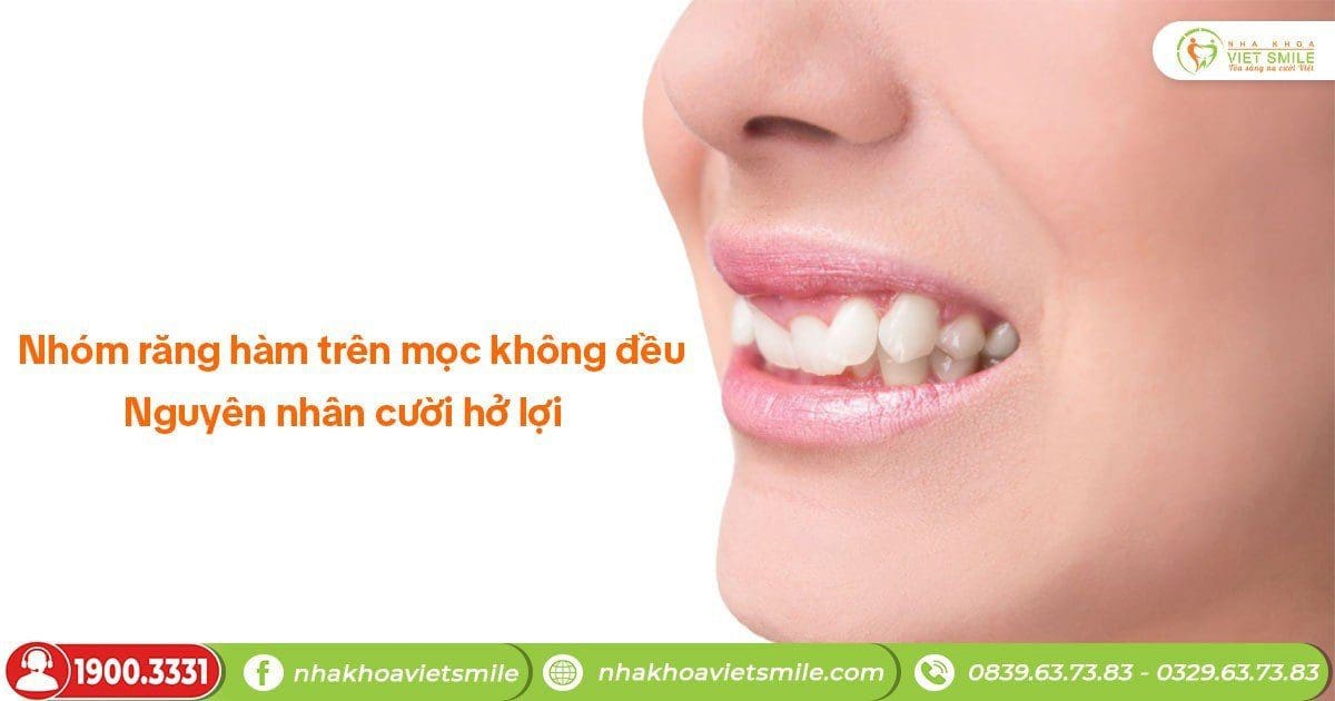 Nhóm răng hàm trên mọc không đều - nguyên nhân cười hở lợi