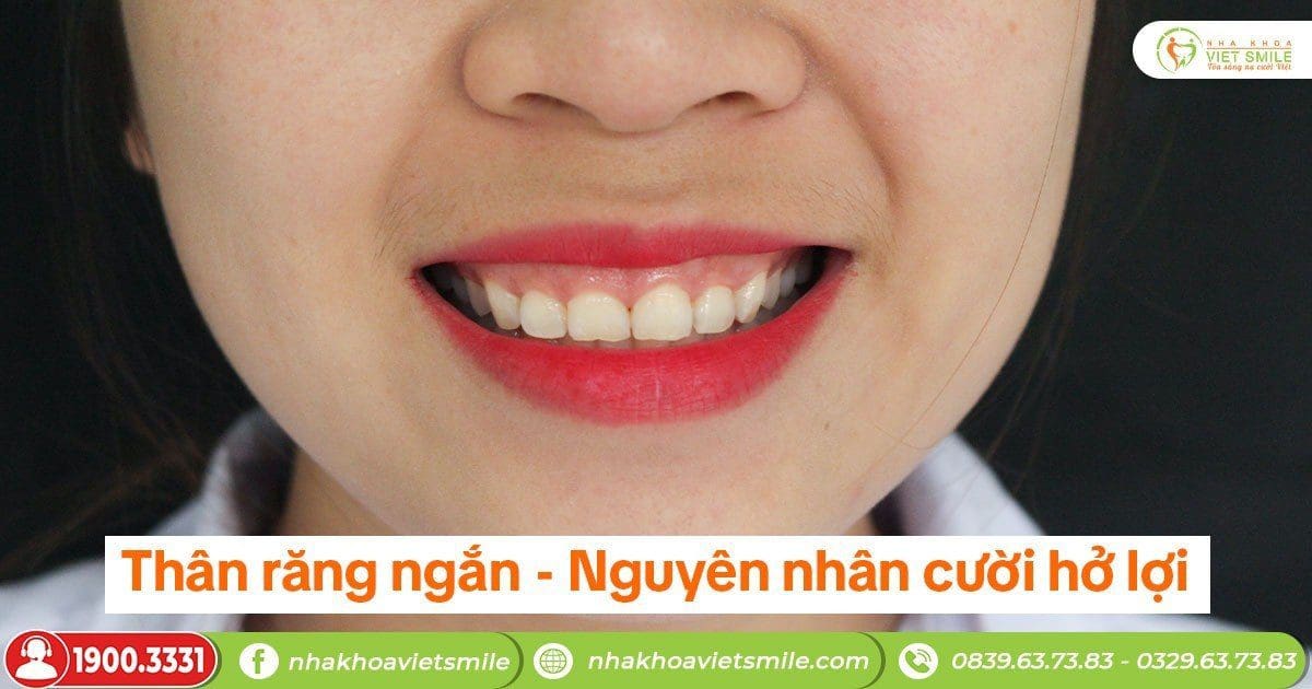 Thân răng ngắn - Nguyên nhân cười hở lợi