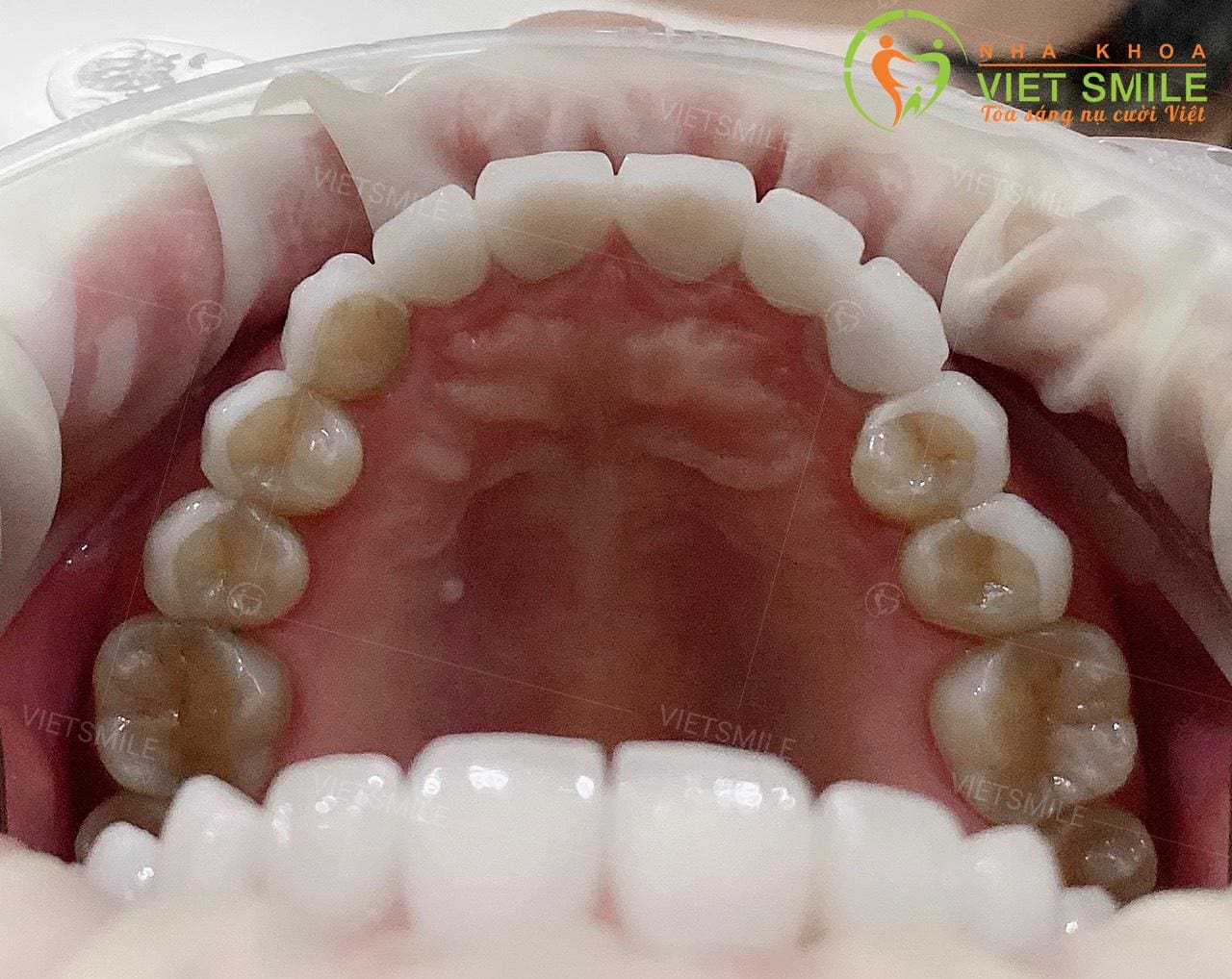 Dùng miếng dán sứ veneer cho răng nhiễm kháng sinh được không? 4 Dan su veneer