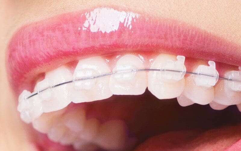 Niềng răng mắc cài sứ ưu điểm là gì?