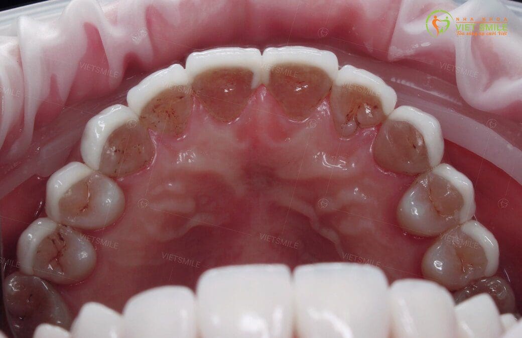 Dùng miếng dán sứ veneer cho răng nhiễm kháng sinh được không? 5 Dan su veneer