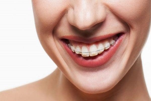 niềng răng hô bao lâu sẽ đẹp? 1 Nieng rang ho