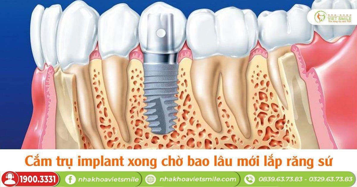 Cắm trụ implant xong chờ bao lâu mới lắp răng sứ?