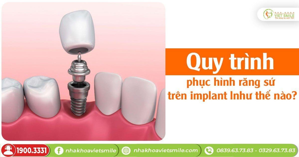 Quy trình phục hình răng sứ trên implant như thế nào?