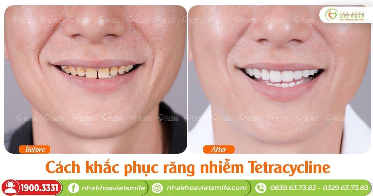 Cách khắc phục răng nhiễm Tetracycline