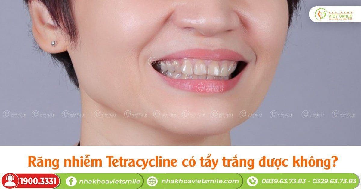 Răng nhiễm Tetracycline có tẩy trắng được không?