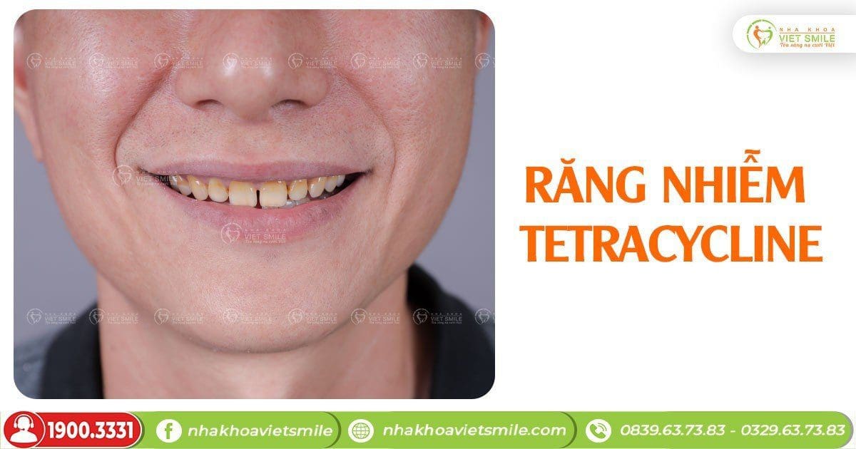 Răng nhiễm Tetracycline