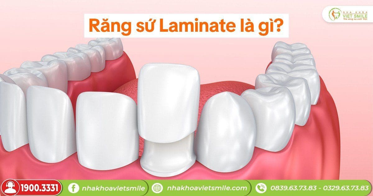 Răng sứ laminate là gì?