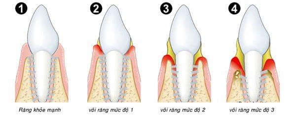 3 mức độ của vôi răng