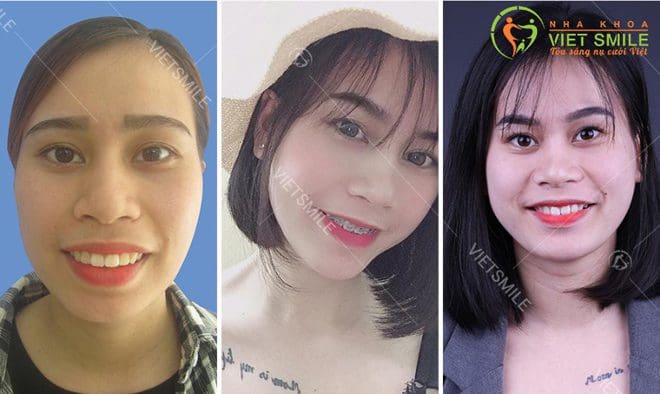 5 vấn đề về niềng răng hô đang được quan tâm nhất hiện nay 1 Nieng rang ho