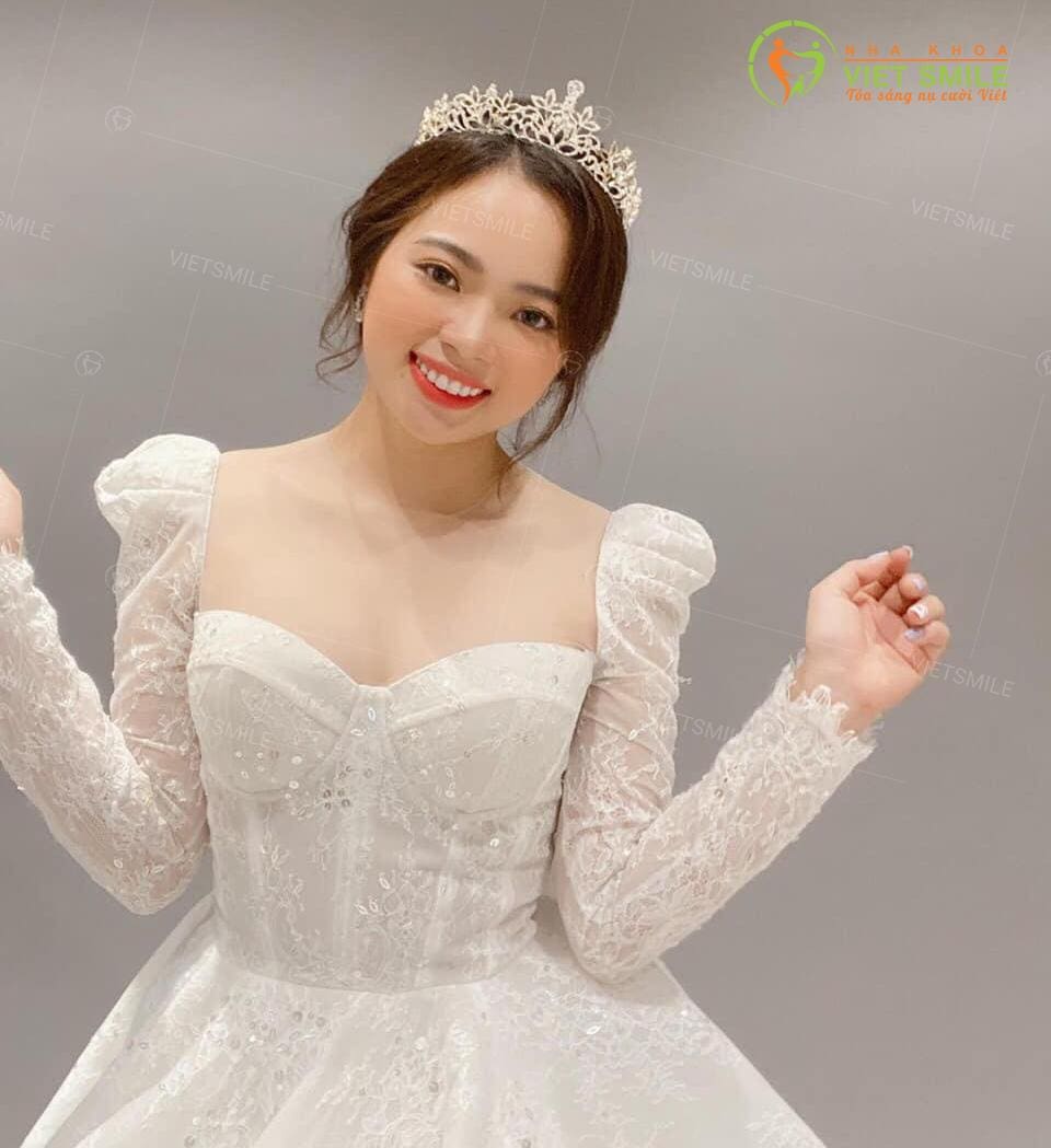 cắt lợi thẩm mỹ bao lâu lành? 1 Vietsmile cat loi tham my xong bao lau lanh