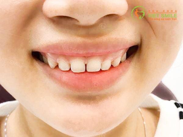 Giá cắt lợi bằng laser bao nhiêu? 2 cắt lợi trùm bằng laser bao nhiêu tiền