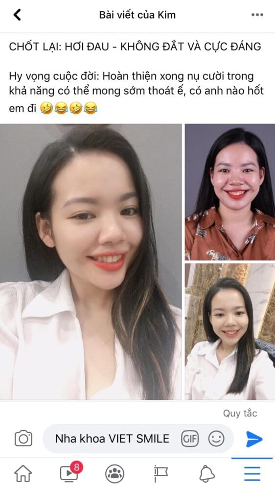 review chữa cười hở lợi 3 Chia se kh cat loi