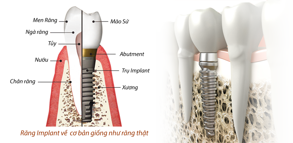 Cấu tạo của răng implant