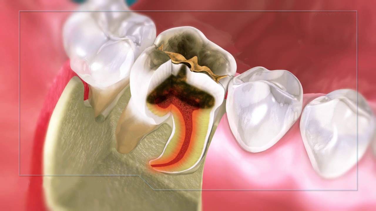 những biến chứng của viêm tủy răng 1 Bien chung viem tuy rang