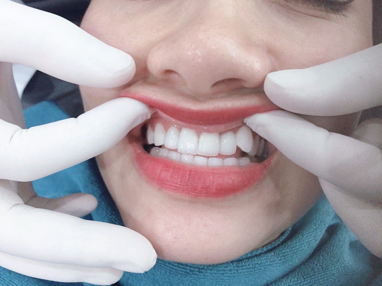 các cách tạo răng khểnh giả hiệu quả nhất 2 Vietsmile tao hinh rang khenh dep