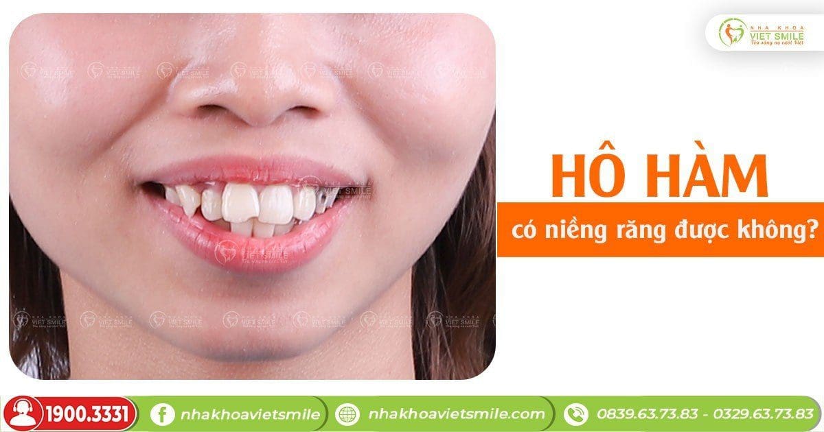 Bị hô hàm có niềng răng được không?