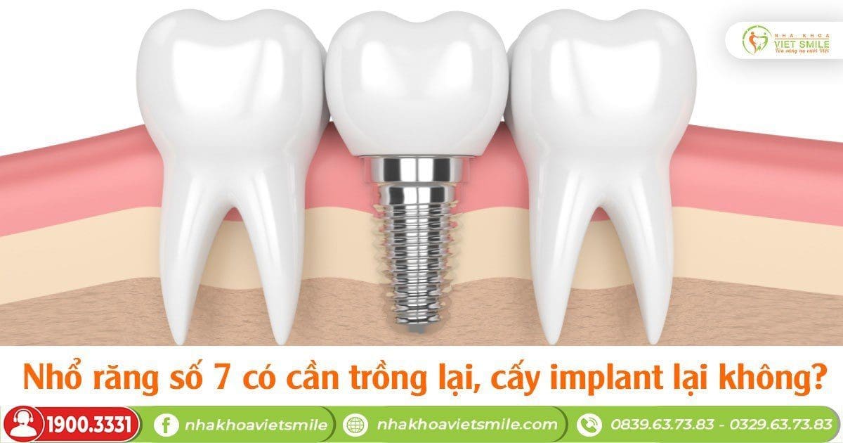 Nhổ răng số 7 có cần trồng lại, cấy implant lại không?