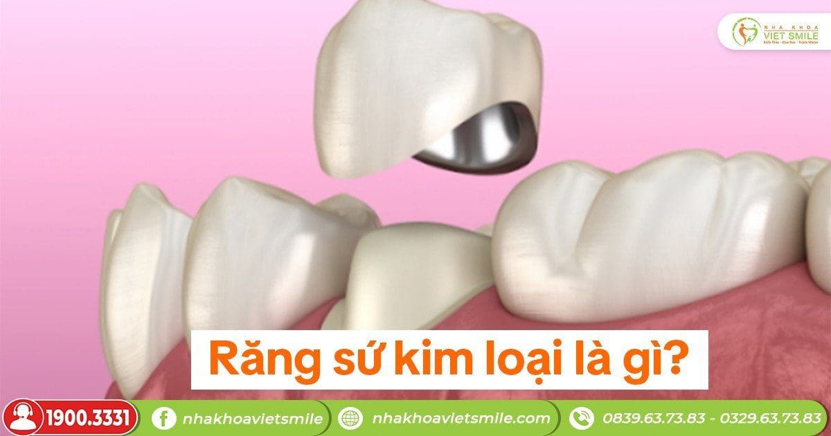 Răng sứ kim loại là gì?